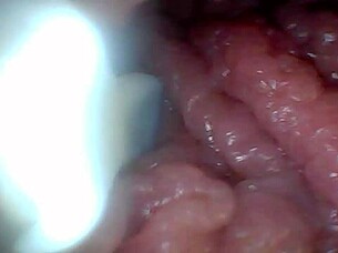 Endoscope camera explores penis's sensitive parts for education